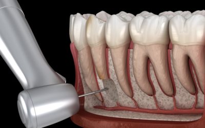 Na czym polega resekcja wierzchołków korzeni zębów?
