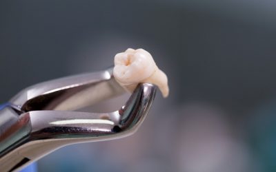 Kiedy konieczne jest dłutowanie zęba?