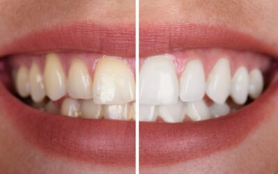 Jakie są metody profesjonalnego wybielania zębów?