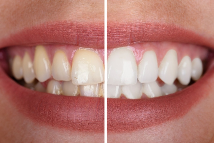efekt wybielania zębów