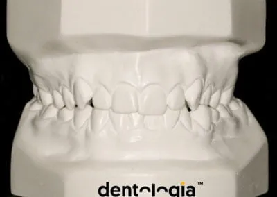 model ortodontyczny